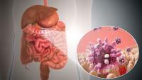 Testing for Gastroenteritis: GI PCR Beats Stool Culture