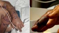 North Carolina contractor bitten on both middle fingers by venomous snake while tearing out deck