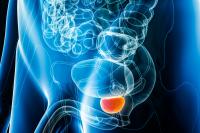 Foods Making Up Most Americans’ Diets Linked to Higher Prostate Cancer Risk