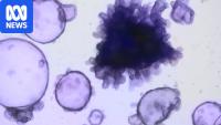 Hopes 'mini guts' will help researchers treat inflammatory bowel disease