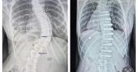 Alberta teen’s family sues government after nearly $200K out-of-country surgical bill