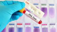 UK men over 50 lose automatic right to prostate cancer tests
