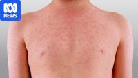 Study warns of measles risk with 1.7 million Australians vulnerable