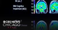 Expert emphasizes how lifestyle and metabolism affect brain health