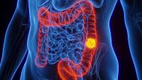 Ca10H Linked to Improved Colorectal Cancer Outcomes