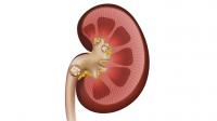 Kidney stones and the painful warning signs not to ignore