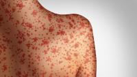 Measles Outbreak Confirmed in Southern Iowa