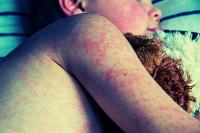 Measles Outbreak Grows as 11 New Cases Confirmed in Iowa