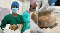 3.1kg Ostrich-Egg Sized Bladder Stone Removed From Sri Lankan Man