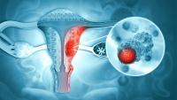 Belgian Algorithm Reshapes Endometrial Cancer Care