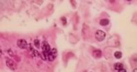Unvaccinated metro Atlanta resident diagnoses with measles