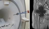 When metal meets magnet: Implant safety in MRI
