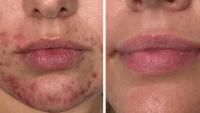 Spot-prone woman 'no longer uses foundation' thanks to £30 'desert island'product