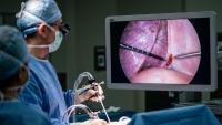 Doctors Put a Camera into Her Chest and Found a Living Lung Fluke Moving on the Pleura