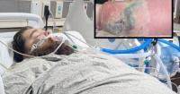 Idaho father in ICU after contracting flesh-eating bacteria in his leg