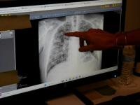 In US mining hub, black lung rates soar