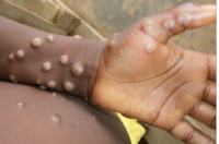 Guinea-Bissau faces first mpox outbreak: UNICEF