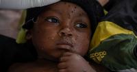 First-ever mpox cases reported in Guinea-Bissau with children the most vulnerable