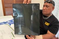 Tongan PALM worker’s injury exposes gaps in Australia’s labour scheme