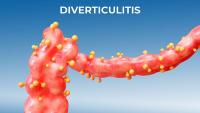 Key Clinical Challenges in Diverticulitis: New ACG Guideline