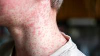 Measles outbreak growing in Wisconsin's Iowa, Lafayette counties