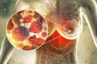Scientists Find Possible Key To Blocking Breast Cancer Before Tumor Forms