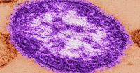 Measles cases rising in southwestern Wisconsin: DHS