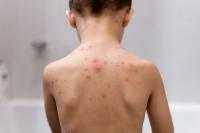 Florida wants to remove school vaccine requirements for chicken pox, Hepatitis B and more
