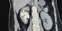 Colorado doctor changing the way he does kidney stone removal surgery
