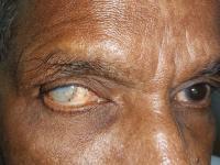 Cataracts drive avoidable blindness in over two million Nigerians – Ophthalmologist