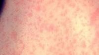 Florida measles cases rise again as RFK Jr. questions US numbers