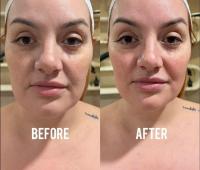 Is This Bone Realignment Facial Beauty’s Next No-Needle Obsession?
