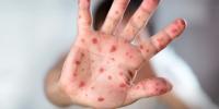 3rd measles case linked to train exposure in Missouri
