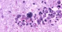 North Carolina teen critically ill from brain-eating amoeba that recently killed Louisiana child