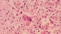 Health department reports 2 more measles-related deaths in Pa.