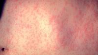 Measles cases rise in Wisconsin as health officials urge back-to-school vaccines