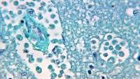 North Carolina teen critically ill after contracting rare 'brain-eating amoeba' infection Health officials in North Carolina confirm a teen in the central part of the state is critically ill after contracting a rare disease caused by Naegleria fowler
