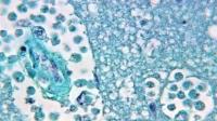Rare Brain-Eating Amoeba Infection Leaves North Carolina Teen Critically Ill