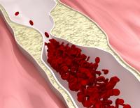 New study detects silent atherosclerosis in healthy young adults