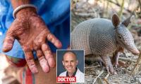 Deadly ancient disease is making a comeback in the US, experts warn... as they reveal the surprising reason why and how to protect yourself