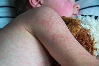 Bangladesh measles toll nears grim 1000-children mark