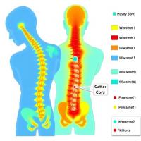 Injury-Site Monitoring After Spinal Cord Injury: 109 Patients Across Five ICUs