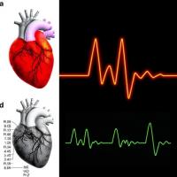 MicroRNA-182 targets IL-6 and HCN4, driving human atrial electrical remodelling
