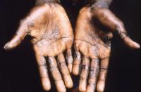 Mpox Keeps Coming Back and Scientists Are Starting to Understand Why