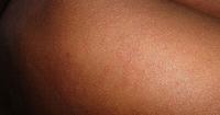 Kentucky health officials report measles exposures in Richmond, Olive Hill