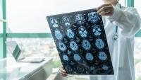 What a Landmark NFL Brain Study Means for San Francisco Brain Injury Victims