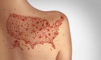 Conflicting information continues in measles-associated death of Pennsylvania newborn