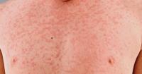 Covering Your Health: U.S. measles cases hit 40-year high; Pennsylvania reports 2 deaths