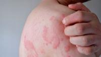 Omalizumab May Ease Inflammation in Chronic Urticaria