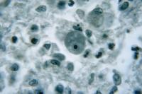 North Carolina Teen Dies From Brain-Eating Amoeba: How To Protect Yourself
